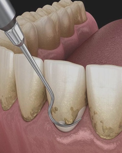 Nelank Dental Periodontic care