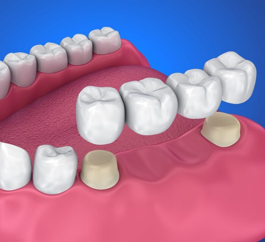 Nelank Dental Crowns and Bridges
